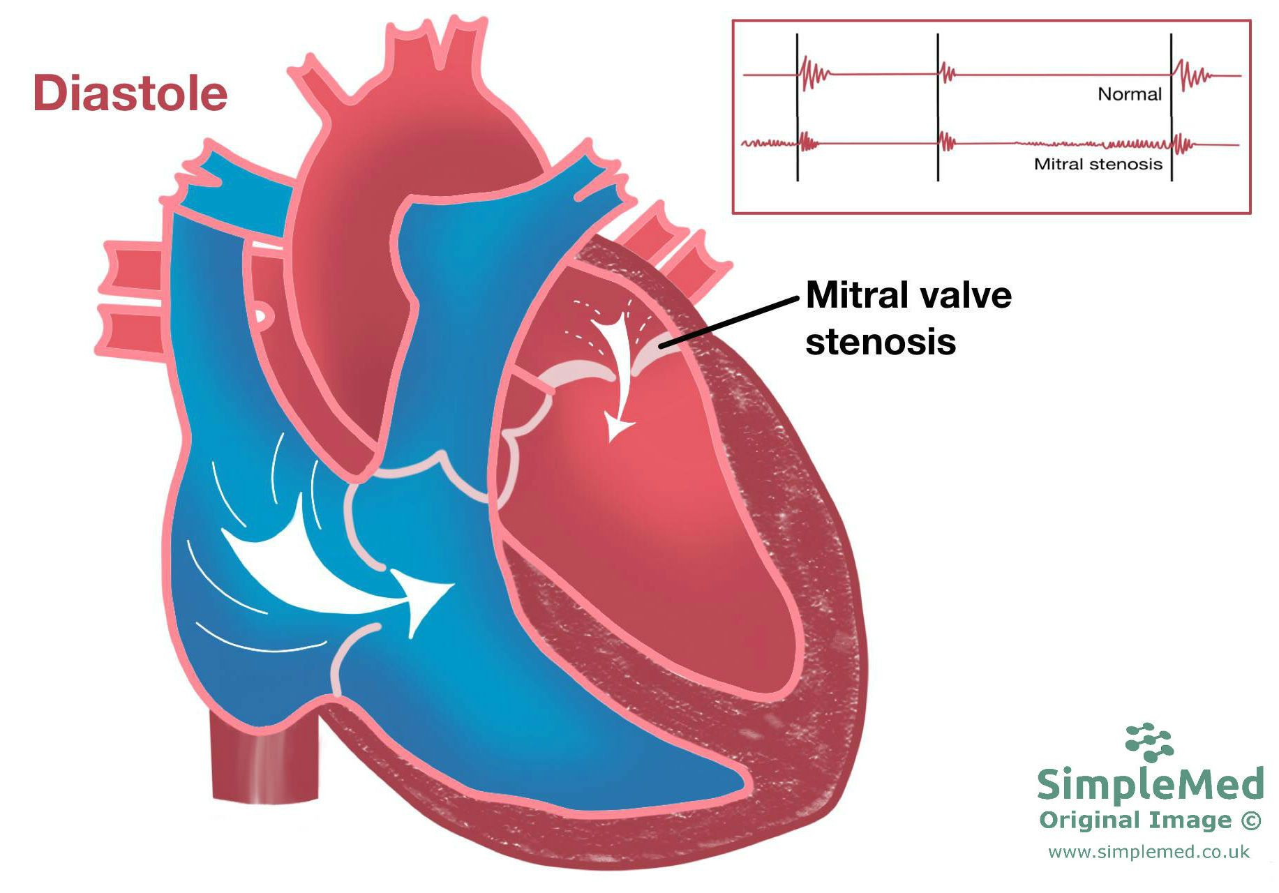 Mitral Valve Stenosis SimpleMed Mitral Valve Stenosis SimpleMed