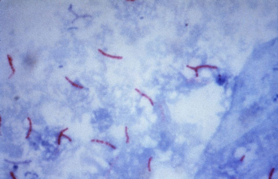 Mycobacterium Tuberculosis SimpleMed Mycobacterium Tuberculosis SimpleMed