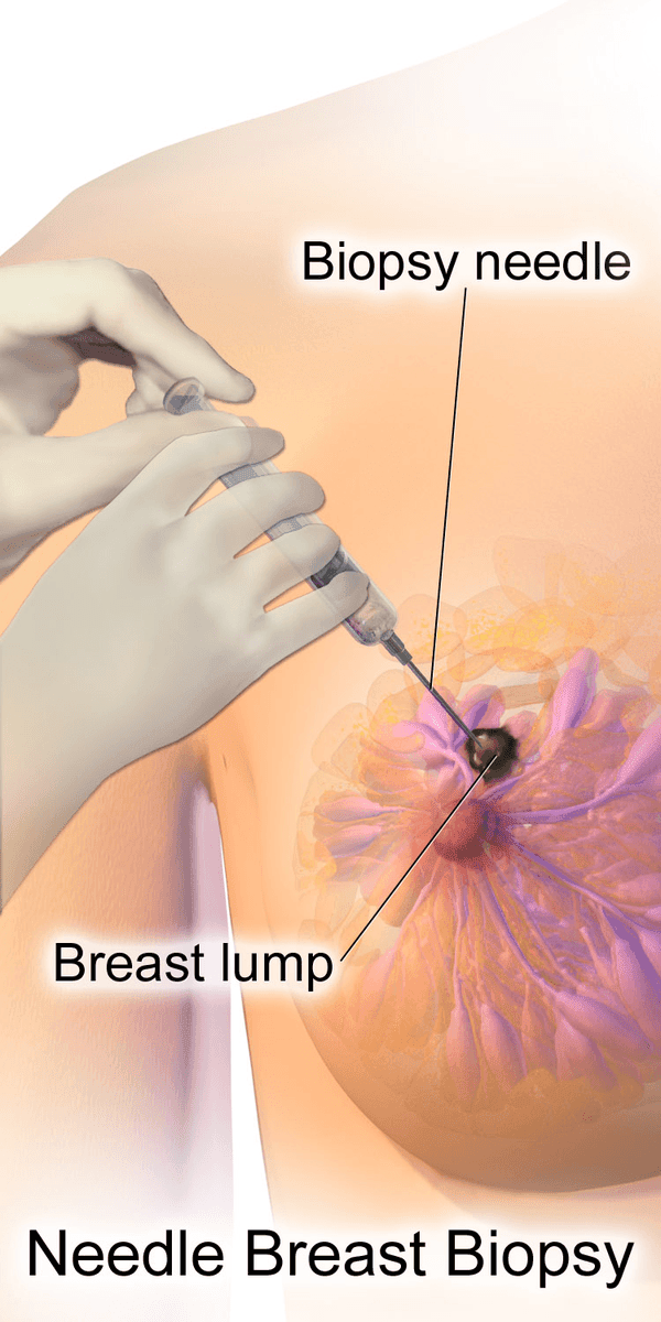 Needle Breast Biopsy SimpleMed Needle Breast Biopsy SimpleMed