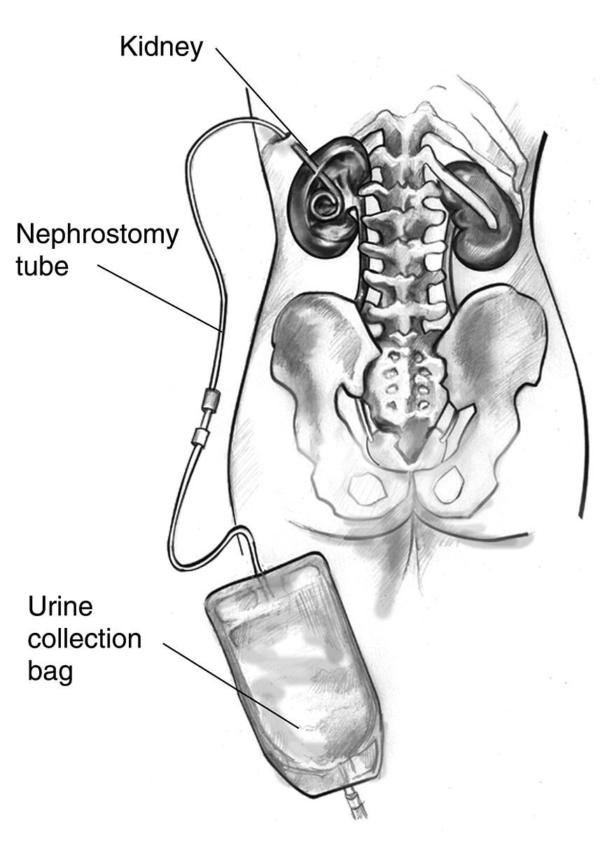 Nephrostomy Tube SimpleMed Nephrostomy Tube SimpleMed