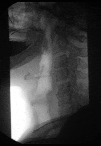 Normal Barium Swallow SimpleMed Normal Barium Swallow SimpleMed