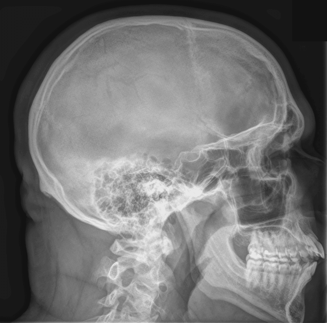Normal Lateral Radiograph of the Skull SimpleMed Normal Lateral Radiograph of the Skull SimpleMed