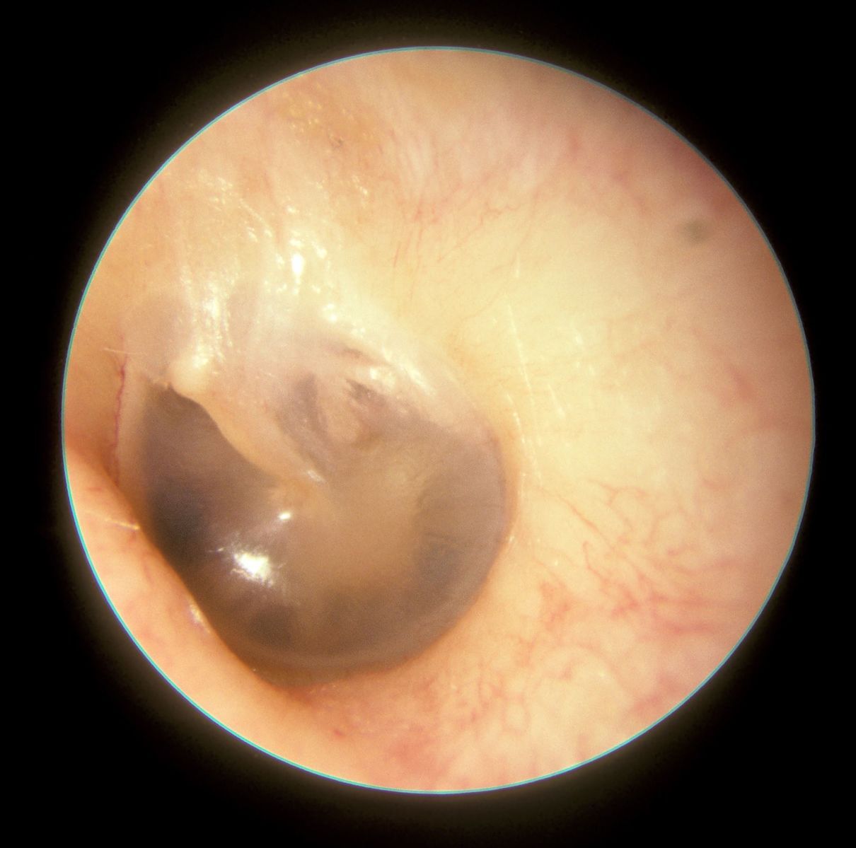 Otoscopy of a Normal Left Tympanic Membrane SimpleMed Otoscopy of a Normal Left Tympanic Membrane SimpleMed