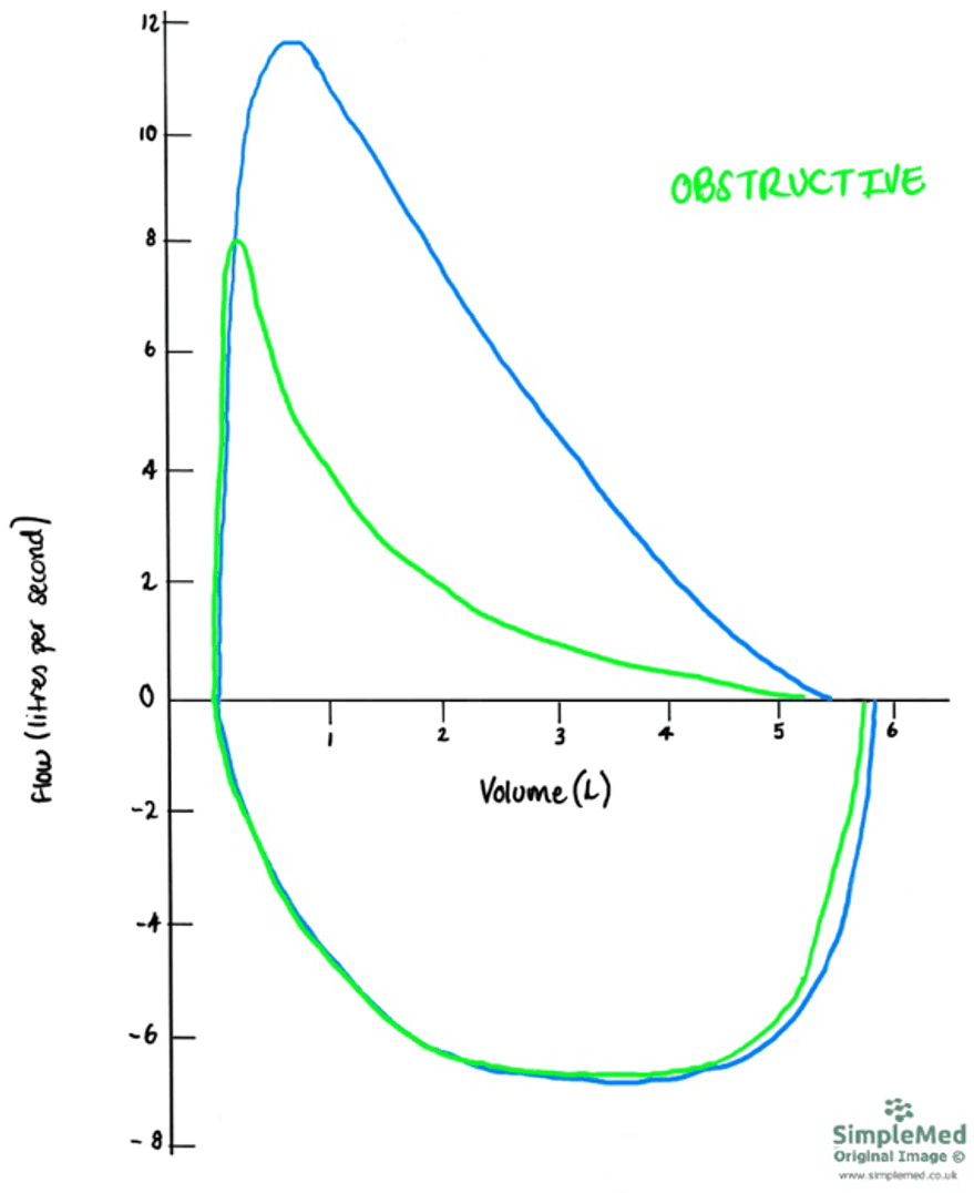 Obstructive Flow Volume Curve SimpleMed Obstructive Flow Volume Curve SimpleMed