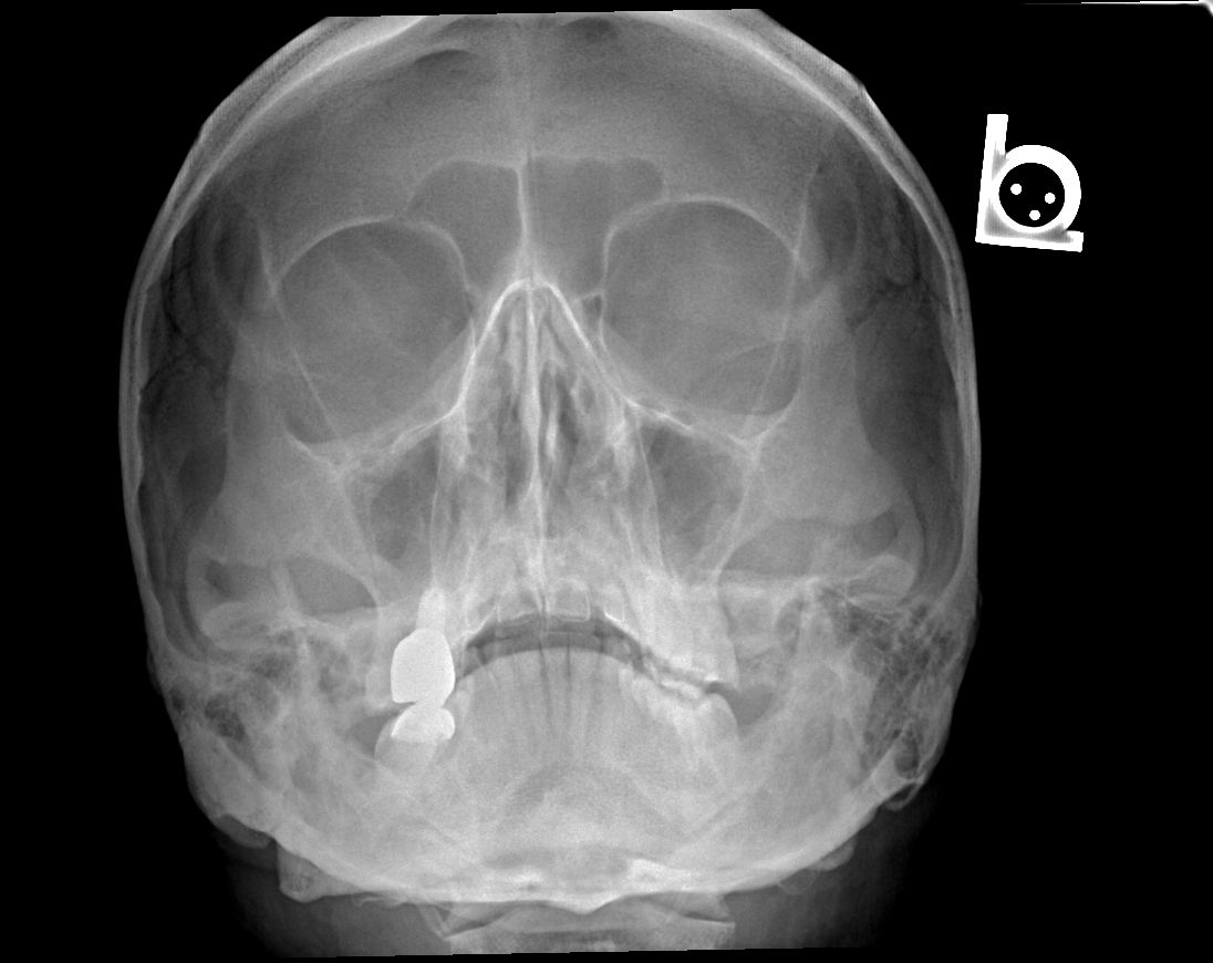 Occipitomental Projection of the Skull SimpleMed Occipitomental Projection of the Skull SimpleMed