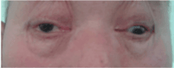 Oculomotor Nerve Palsy SimpleMed Oculomotor Nerve Palsy SimpleMed