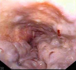 Oesophageal Varices SimpleMed Oesophageal Varices SimpleMed