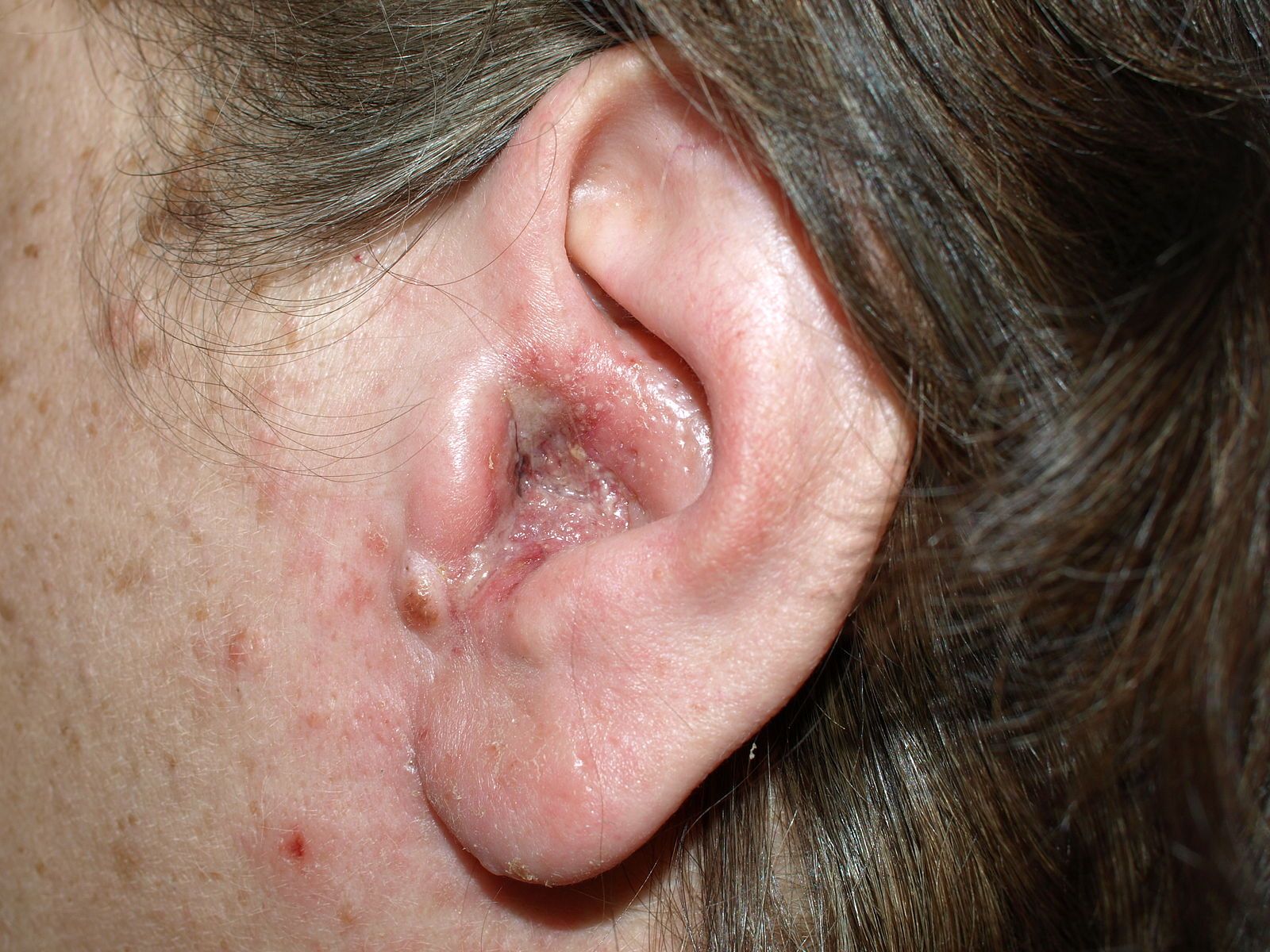 Otitis Externa SimpleMed