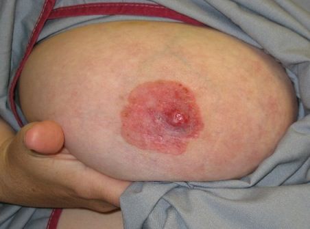 Paget's Disease of the Nipple SimpleMed Paget's Disease of the Nipple SimpleMed
