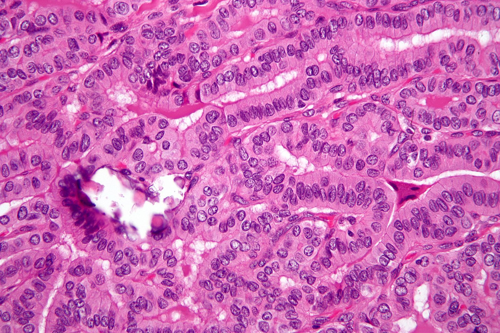 Papillary Thyroid Adenocarcinoma Histology SimpleMed Papillary Thyroid Adenocarcinoma Histology SimpleMed