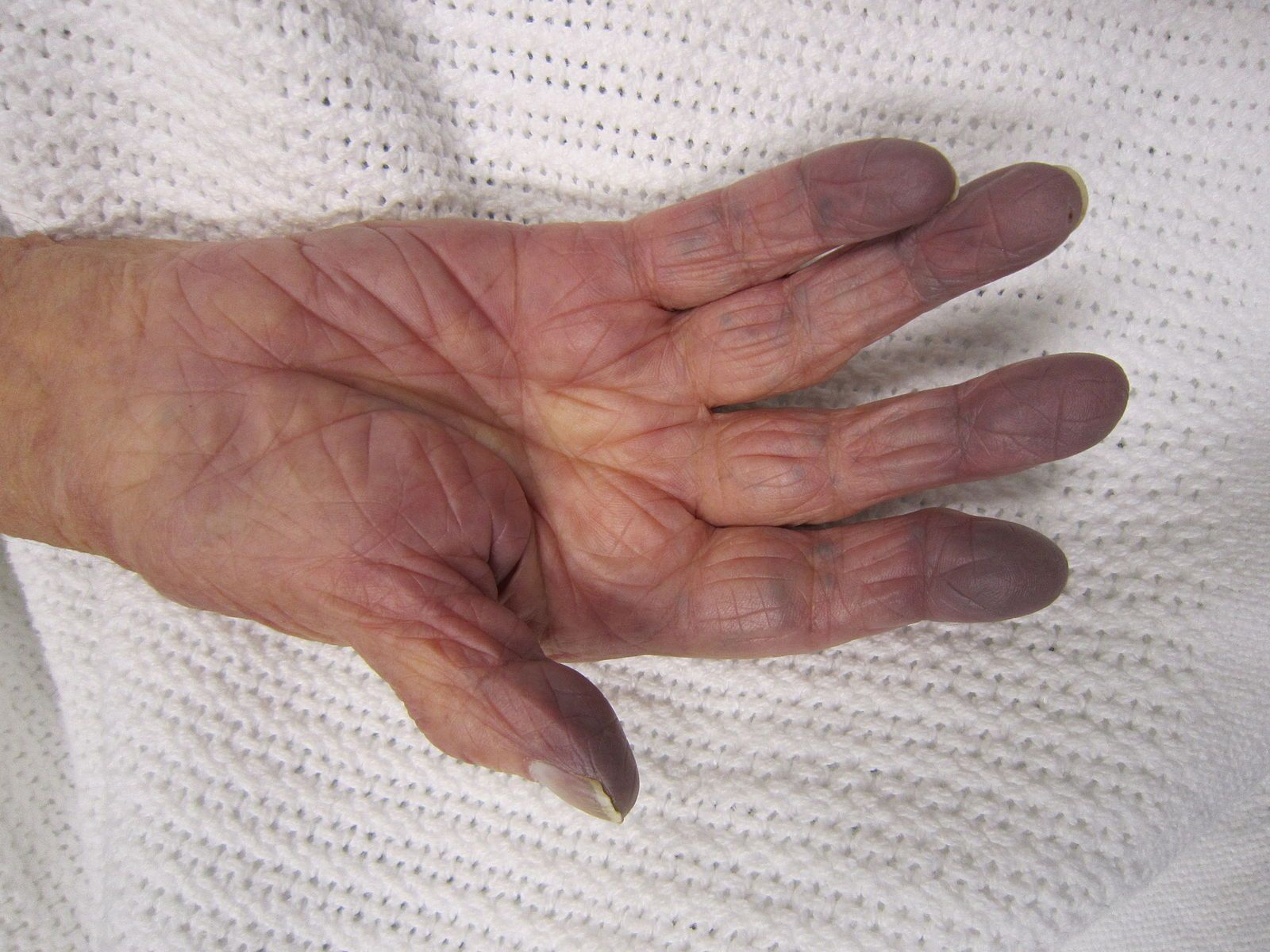 Peripheral Cyanosis SimpleMed Peripheral Cyanosis SimpleMed