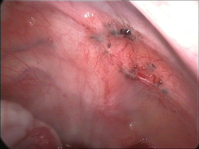 Peritoneal Endometriosis SimpleMed Peritoneal Endometriosis SimpleMed