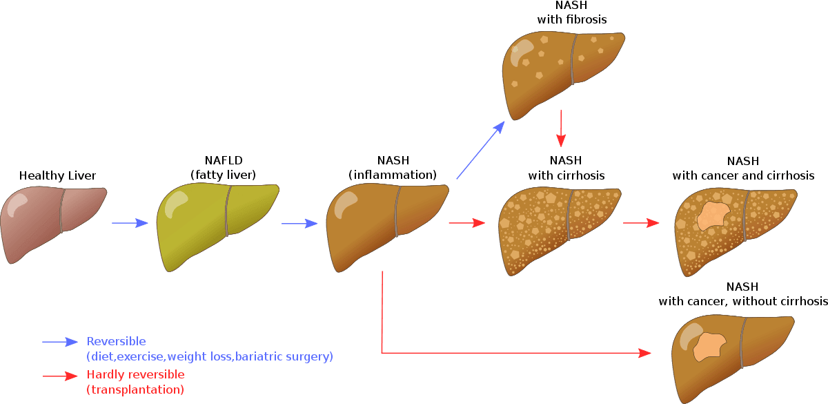 Progression of Non-Alcoholic Fatty Liver Disease (NAFLD) SimpleMed Progression of Non-Alcoholic Fatty Liver Disease (NAFLD) SimpleMed