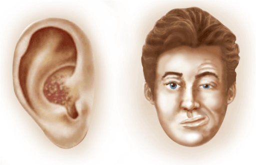Ramsey Hunt Syndrome SimpleMed