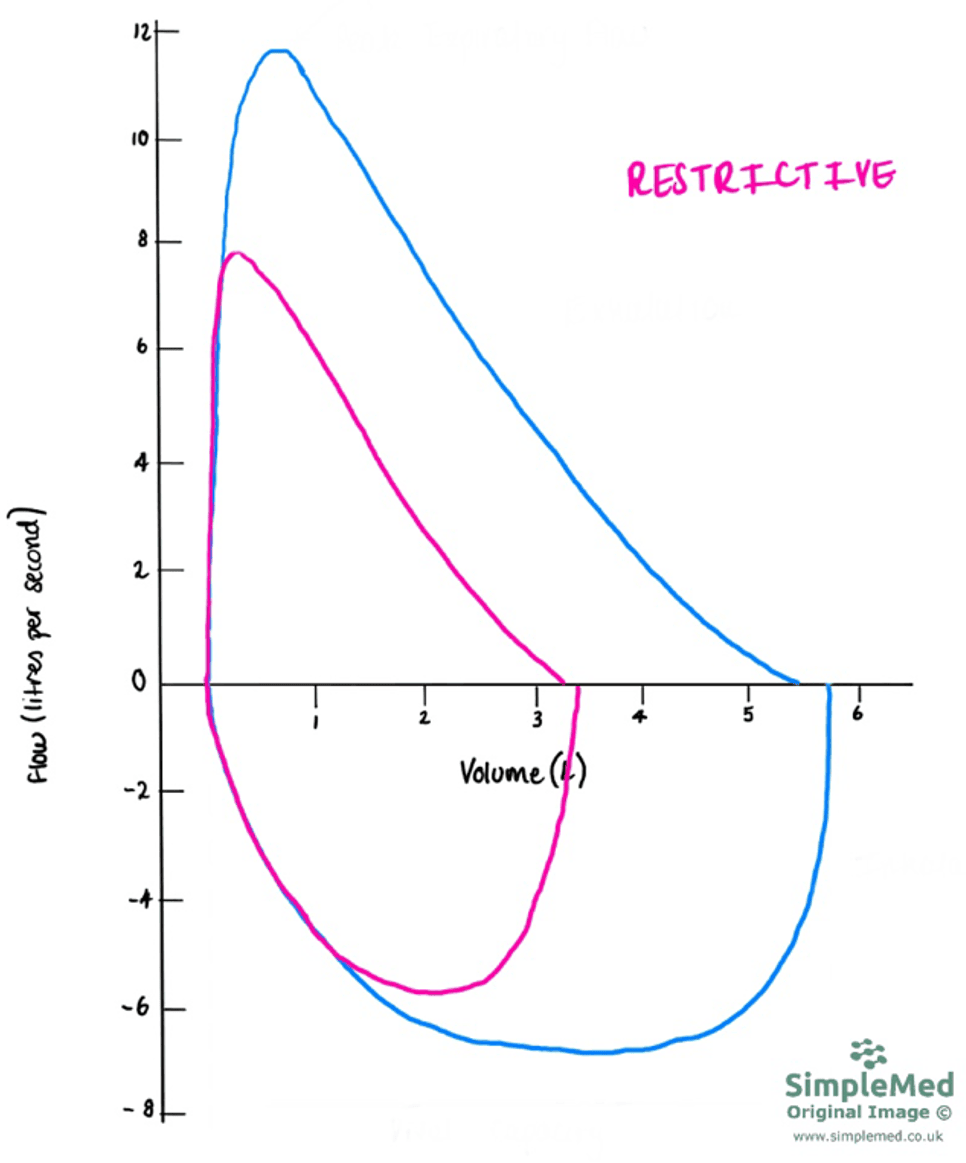 Restrictive Flow Volume Curve SimpleMed Restrictive Flow Volume Curve SimpleMed