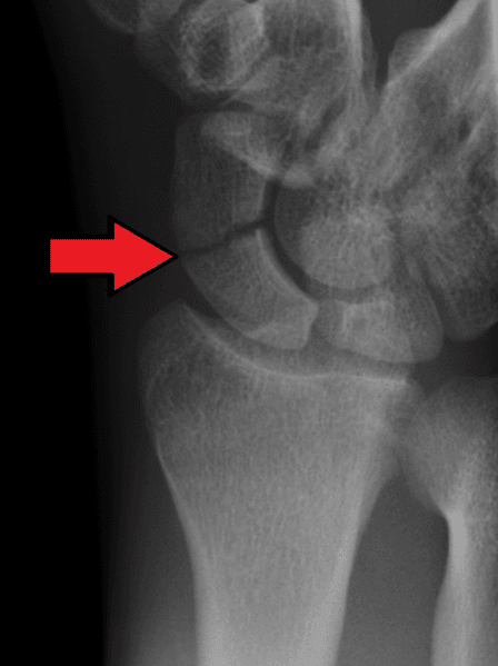 Scaphoid Fracture X-Ray SimpleMed Scaphoid Fracture X-Ray SimpleMed