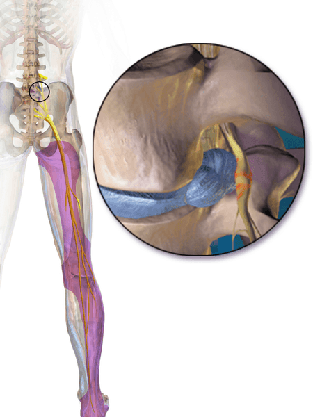 Sciatica SimpleMed Sciatica SimpleMed