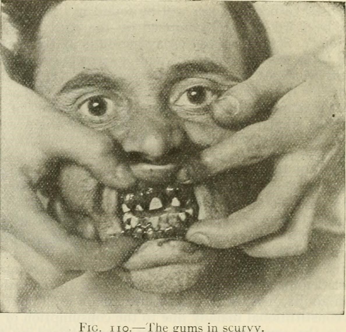 Scurvy Patient with Swollen Gums SimpleMed Scurvy Patient with Swollen Gums SimpleMed