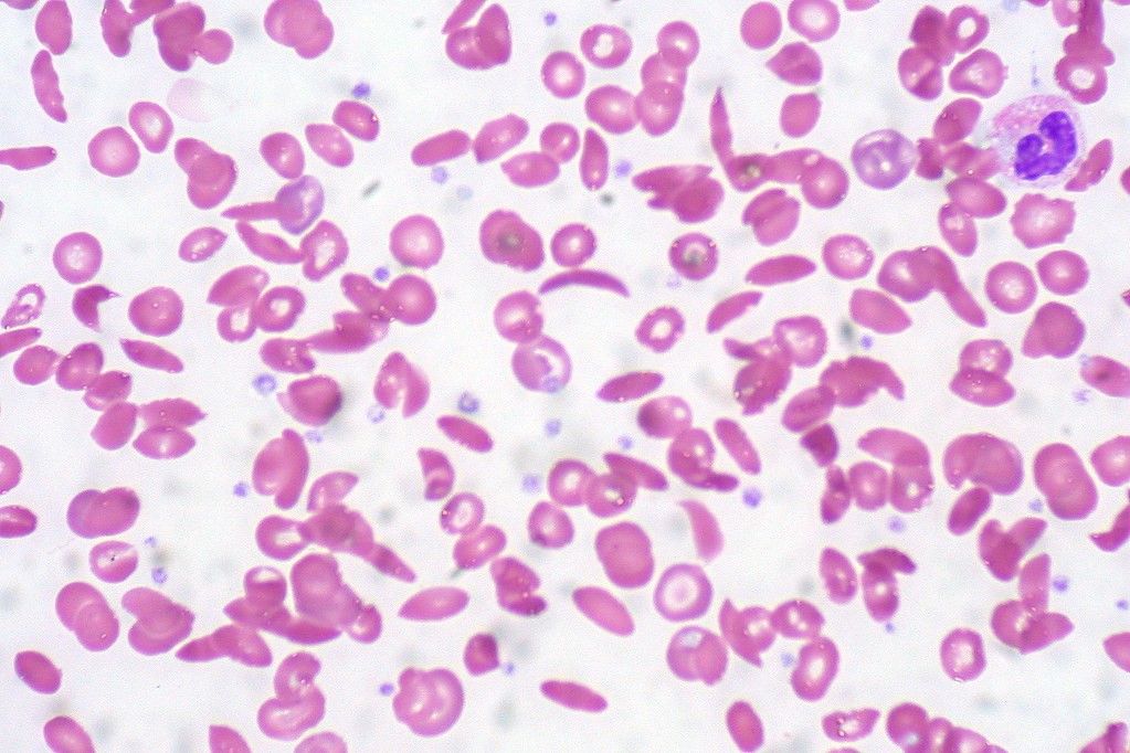 Sickle cell anaemia blood film SimpleMed Sickle cell anaemia blood film SimpleMed