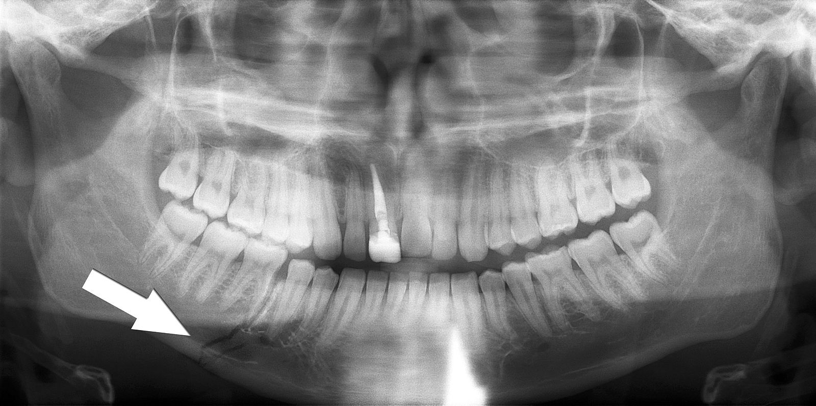 Simple Mandible Fracture X-ray SimpleMed Simple Mandible Fracture X-ray SimpleMed
