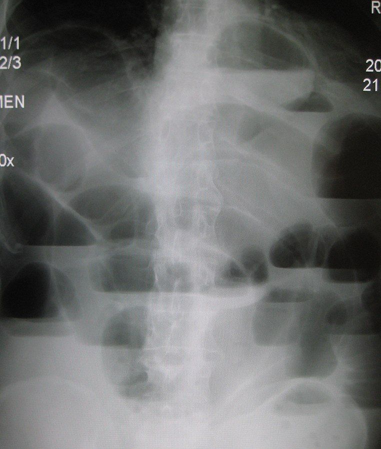 Small Bowel Obstruction X-ray SimpleMed Small Bowel Obstruction X-ray SimpleMed