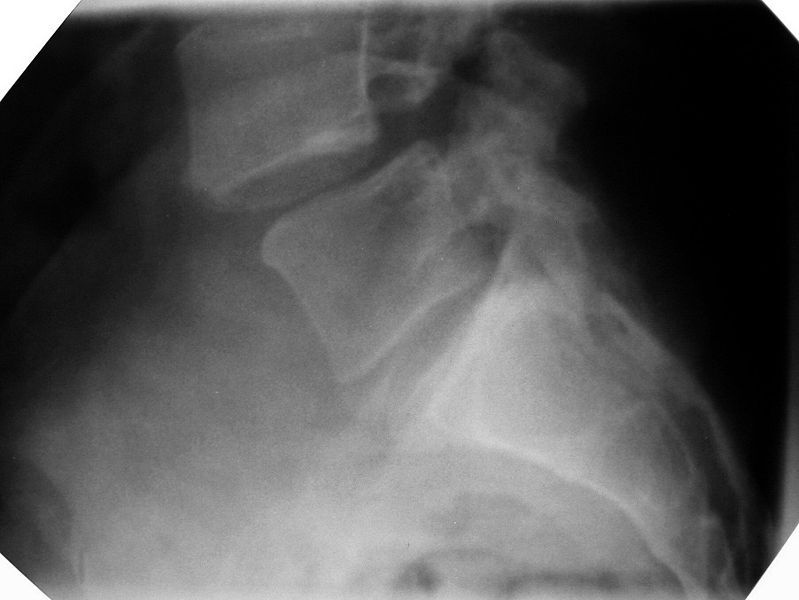 Spondylolisthesis SimpleMed Spondylolisthesis SimpleMed