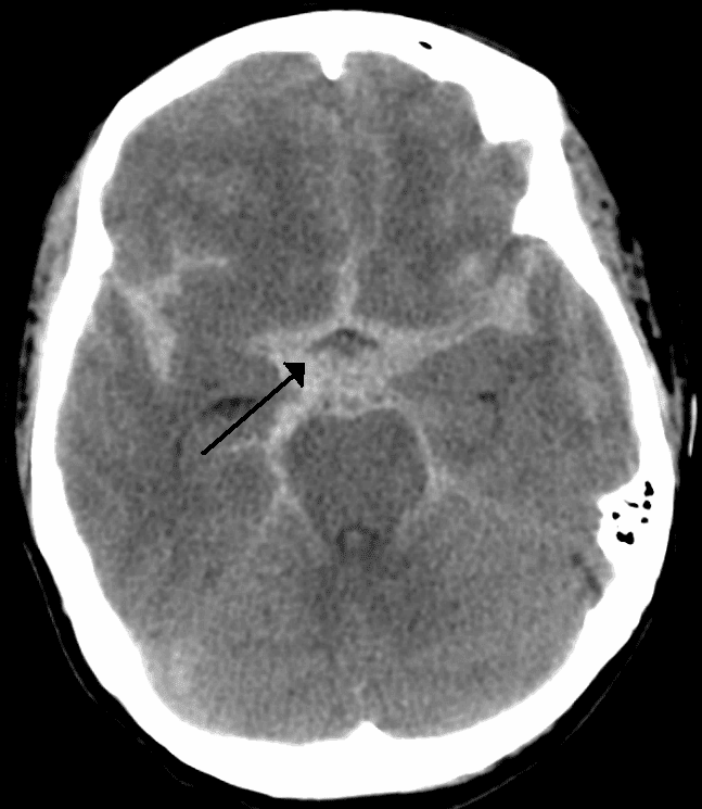 Subarachnoid Haemorrhage SimpleMed Subarachnoid Haemorrhage SimpleMed