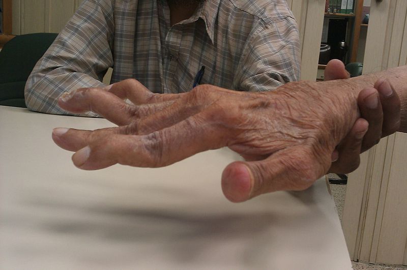 Swan Neck Deformity SimpleMed