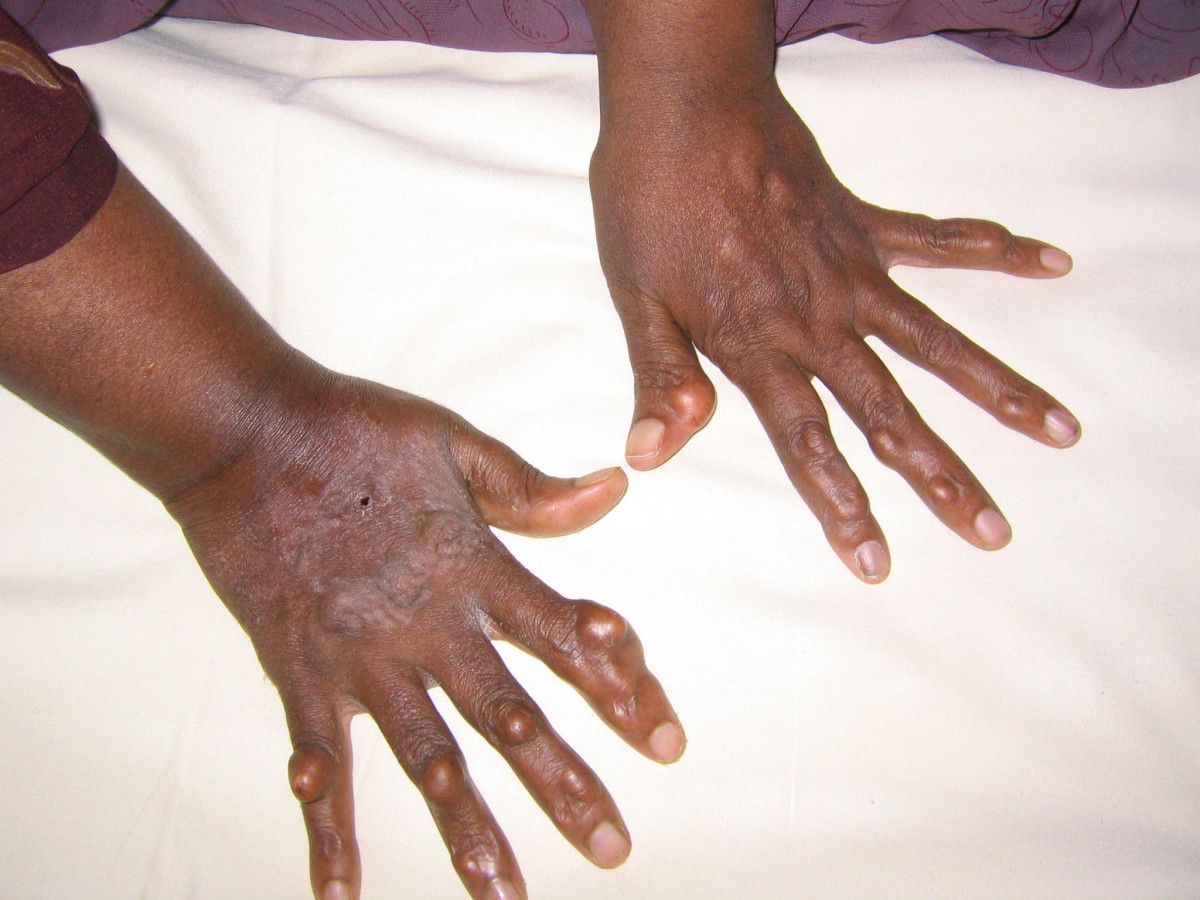 Tendinous Xanthoma SimpleMed Tendinous Xanthoma SimpleMed