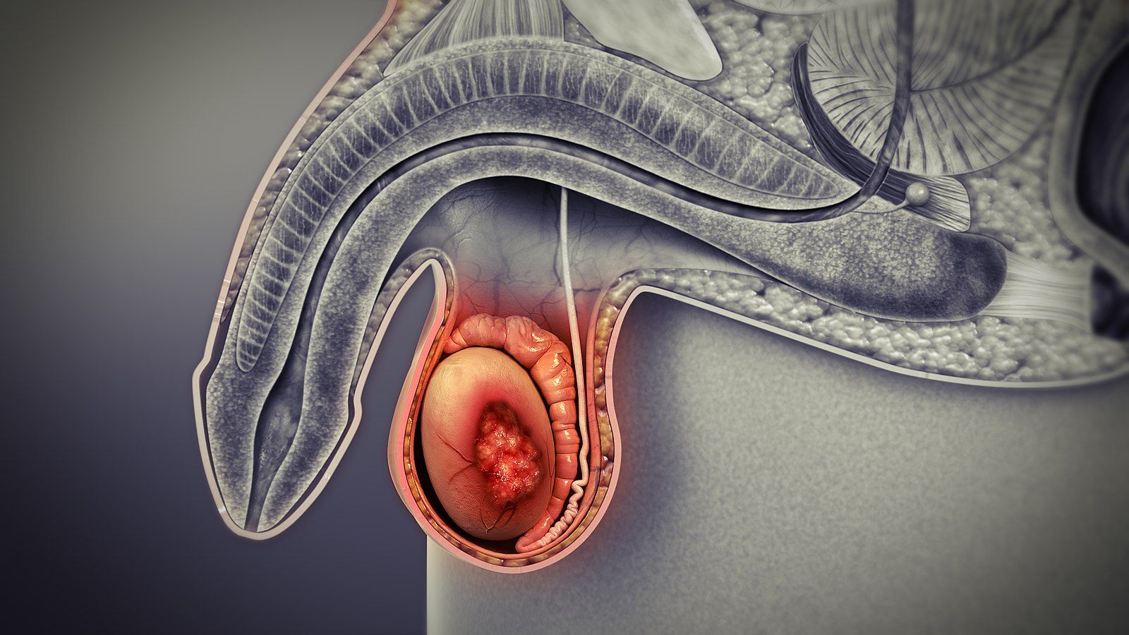 Testicular Cancer SimpleMed Testicular Cancer SimpleMed