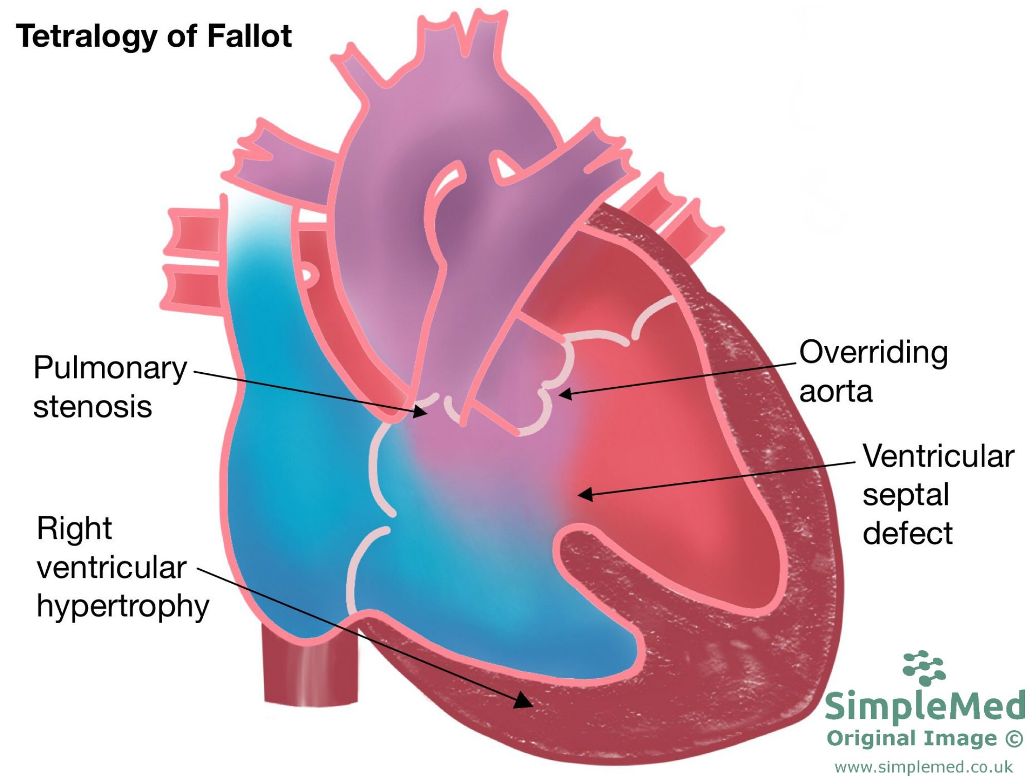 Tetralogy of fallot congenital heart defect SimpleMed Tetralogy of fallot congenital heart defect SimpleMed