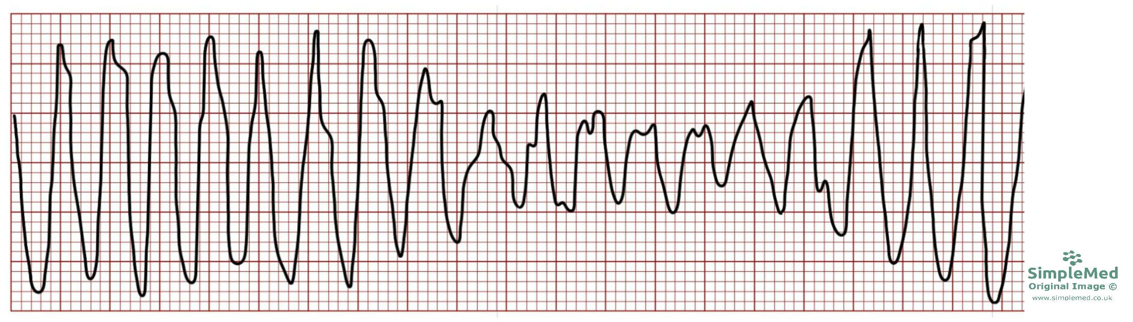 Torsades de Pointes ECG changes SimpleMed Torsades de Pointes ECG changes SimpleMed
