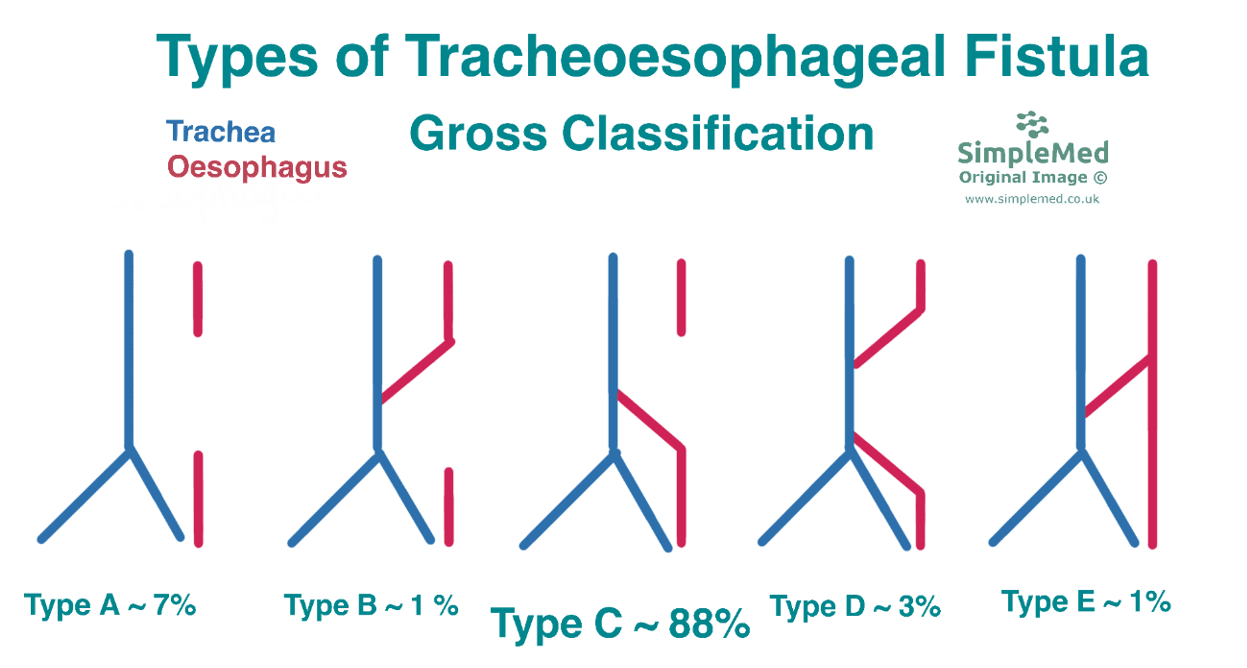 Types of Tracheoesophageal Fistula SimpleMed Types of Tracheoesophageal Fistula SimpleMed