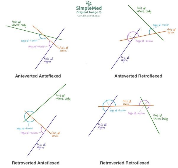 Types of Retroversion and Retroflexion SimpleMed Types of Retroversion and Retroflexion SimpleMed
