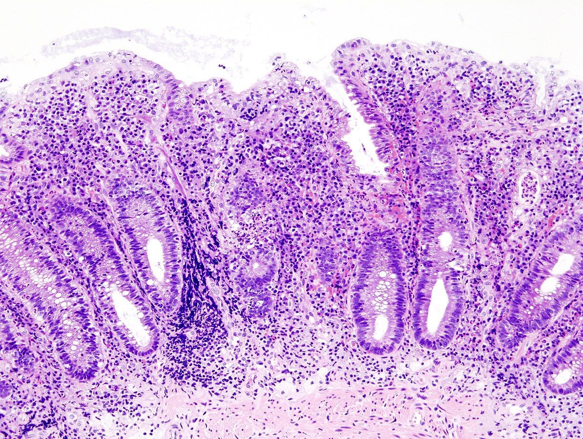Ulcerative Colitis Endoscopic Biopsy SimpleMed Ulcerative Colitis Endoscopic Biopsy SimpleMed
