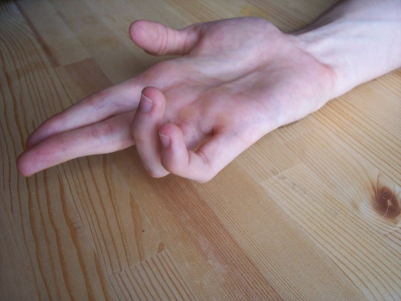 Ulnar Claw Deformity SimpleMed Ulnar Claw Deformity SimpleMed
