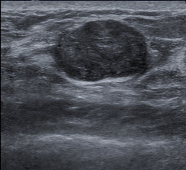 Ultrasound Image of Breast Fibroadenoma SimpleMed Ultrasound Image of Breast Fibroadenoma SimpleMed