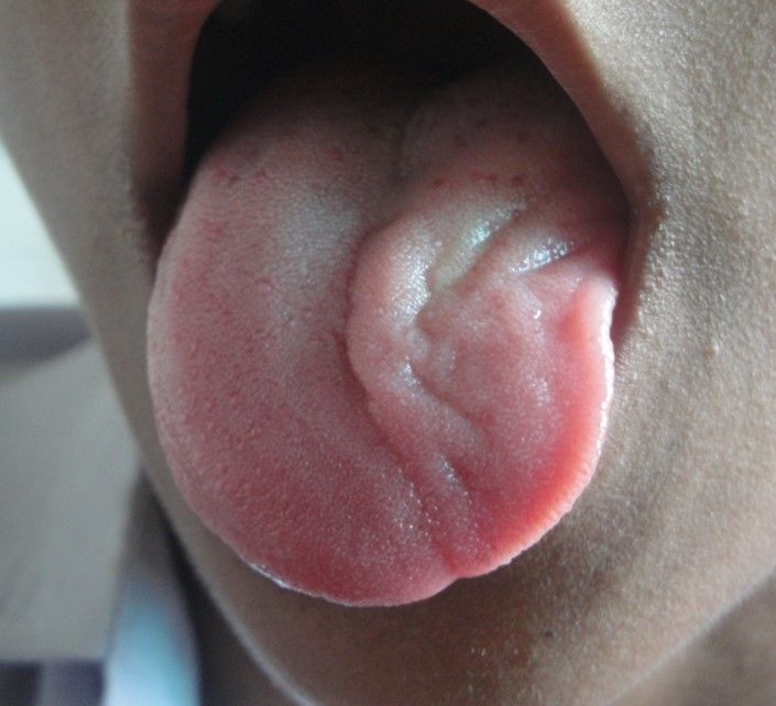 Unilateral Hypoglossal Nerve Palsy SimpleMed Unilateral Hypoglossal Nerve Palsy SimpleMed