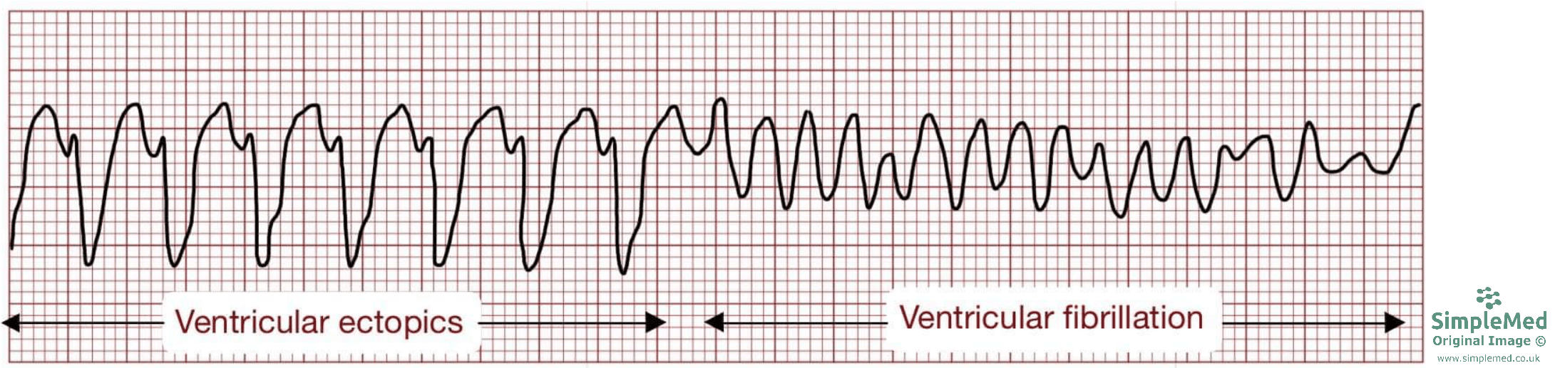 Ventricular Tachycardia ECG SimpleMed Ventricular Tachycardia ECG SimpleMed