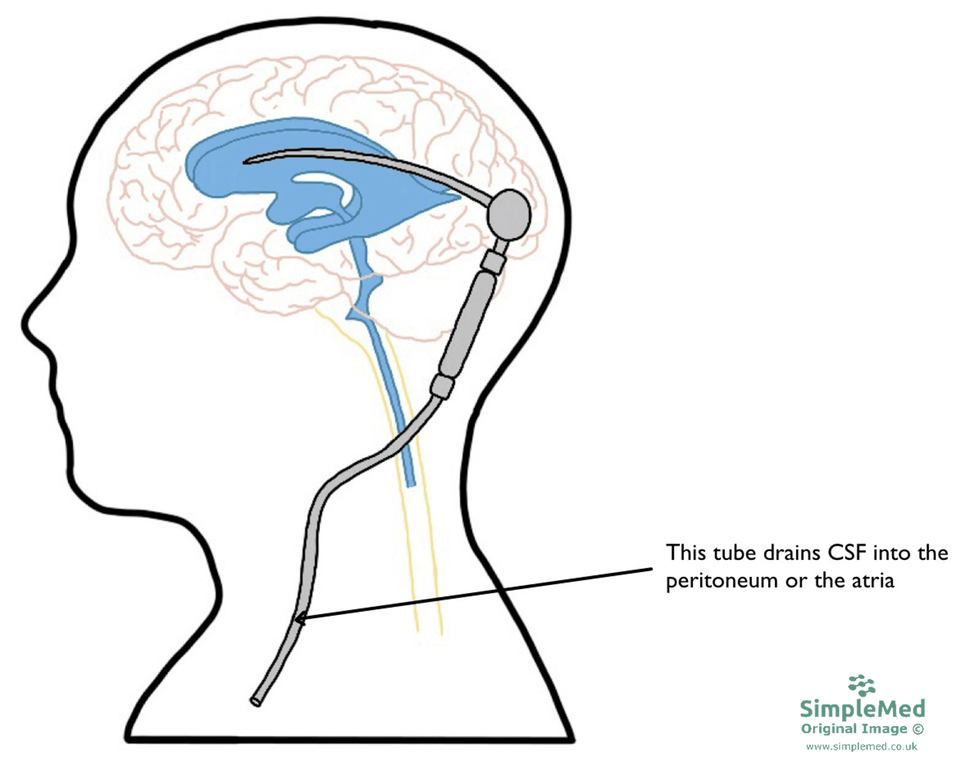 Ventricular Shunt for CSF Drainage SimpleMed