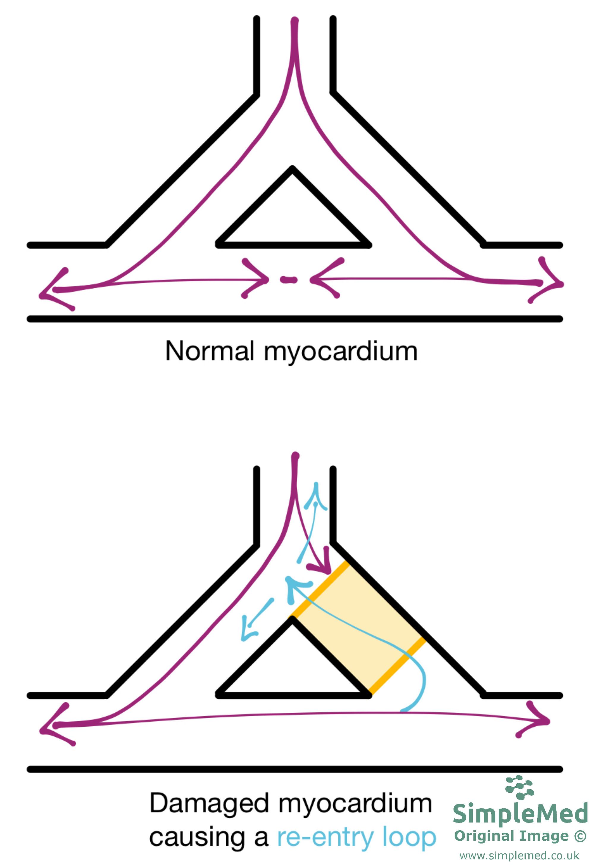 Re-Entry Loop in the Myocardium SimpleMed Re-Entry Loop in the Myocardium SimpleMed