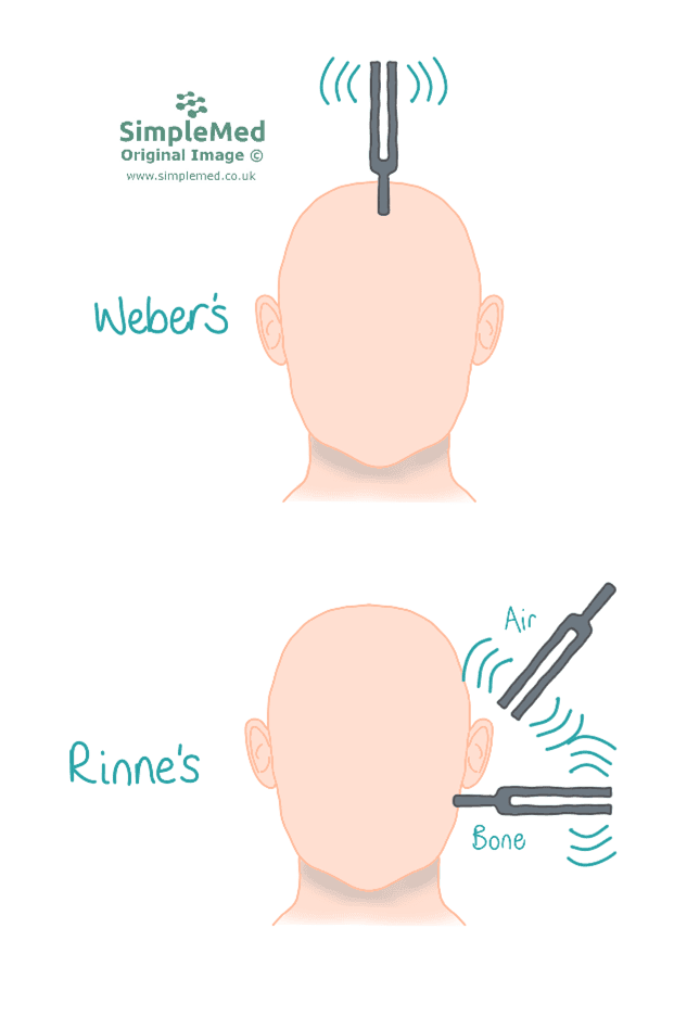 Weber's and Rinne's Test SimpleMed Weber's and Rinne's Test SimpleMed