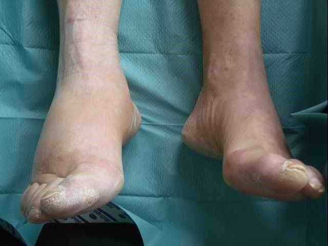Charcot Arthropathy SimpleMed Charcot Arthropathy SimpleMed