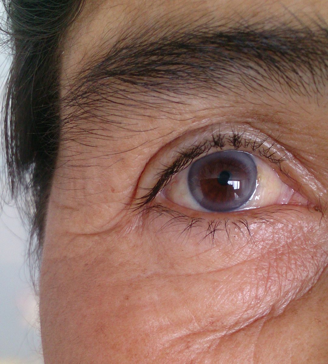 Corneal Arcus SimpleMed Corneal Arcus SimpleMed