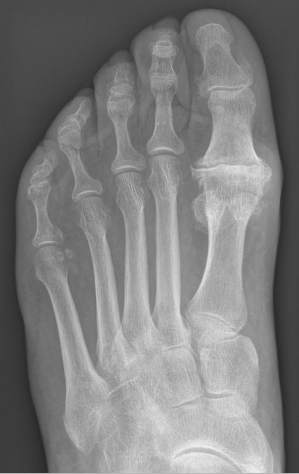 Hallux Rigidus SimpleMed Hallux Rigidus SimpleMed