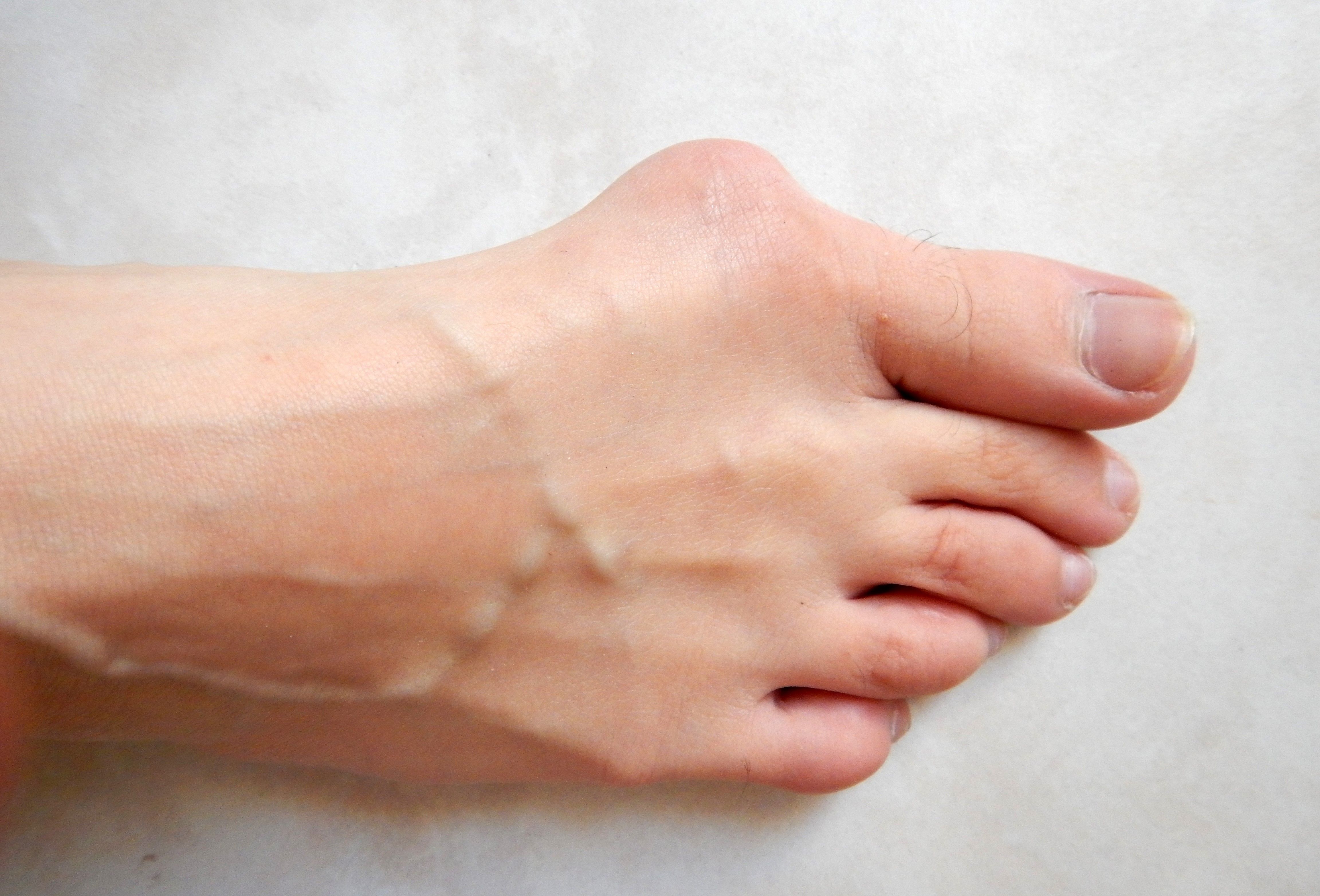 Hallux Valgus SimpleMed Hallux Valgus SimpleMed