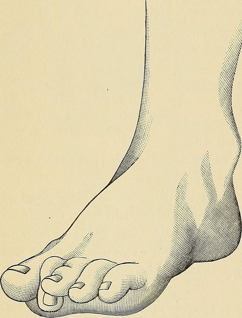 Hammer Toe SimpleMed Hammer Toe SimpleMed