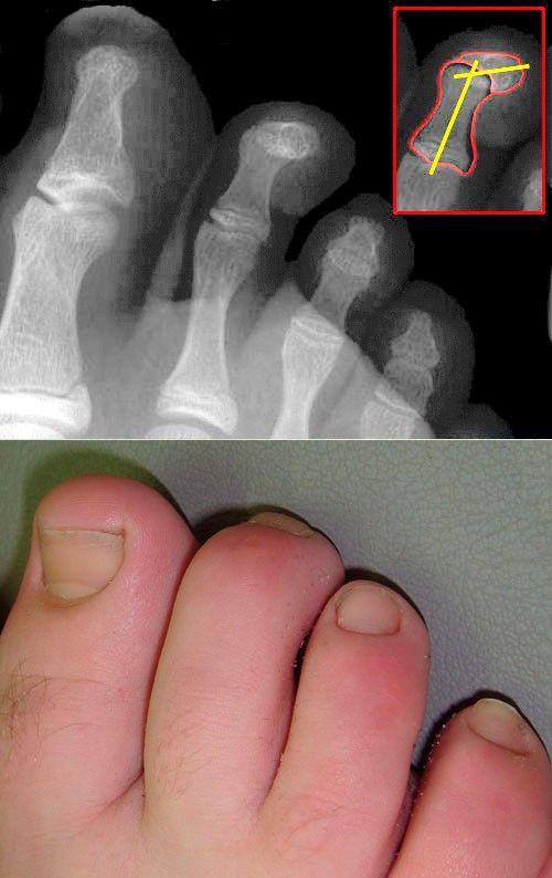 Mallet Toe SimpleMed Mallet Toe SimpleMed