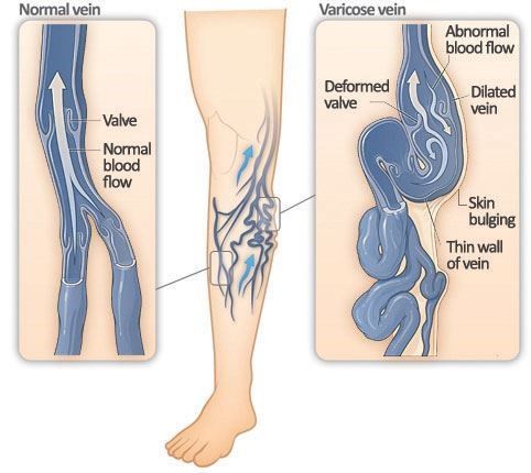 Difference between a normal and varicose vein SimpleMed Difference between a normal and varicose vein SimpleMed